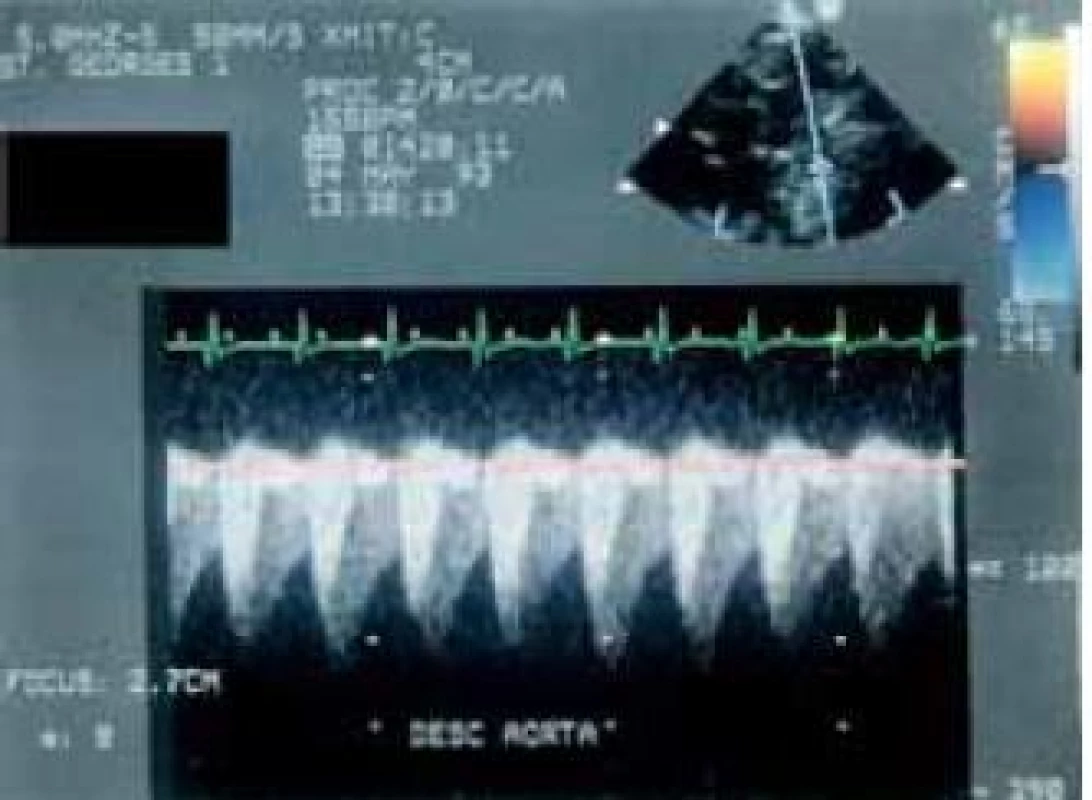 Kontinuální spektrální dopplerovská echokardiografie dítěte s koarktací aorty. Dvojitá denzita je způsobena superpozicí toků proximálně a distálně od léze. Není velké zvýšení vrcholové rychlosti toku, ale tok za restrikcí je kontinuální během celého cyklu.