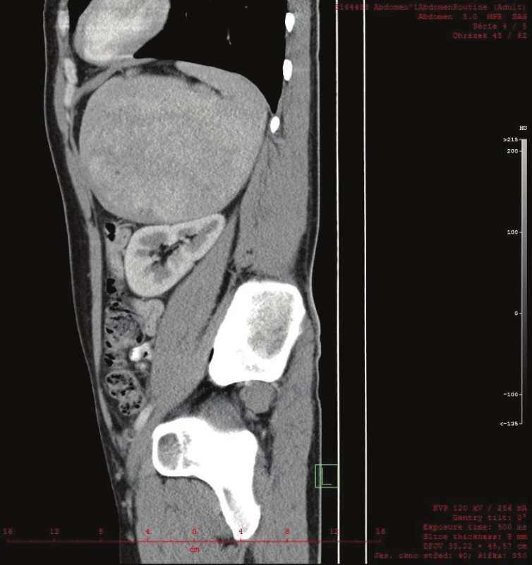 CT sagitální řez zachycuje kulovitou expanzi v těsném vztahu k levé ledvině, bez možnosti diferencovat nadledvinu
Fig. 4: A sagittal CT scan shows a round expansion in close proximity to the left kidney. The suprarenal gland could not be differentiated