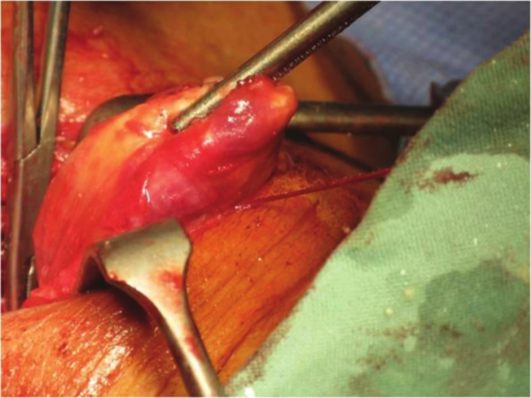 Příštítný nádor
Fig. 3: Parathyroid Tumour