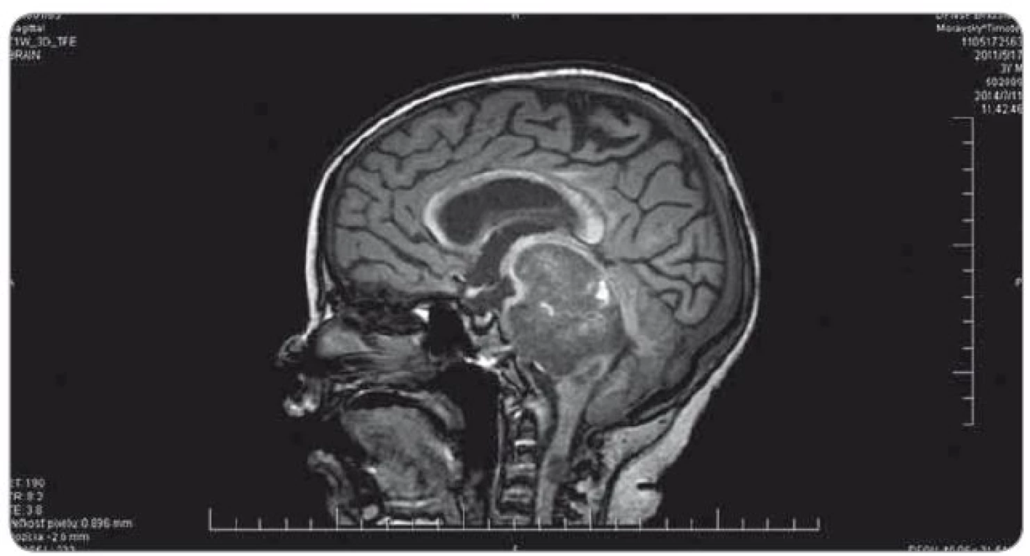 MRI realizované po podaní dvoch frakcií rádioterapie na ložisko nádoru (11. 7. 2014).