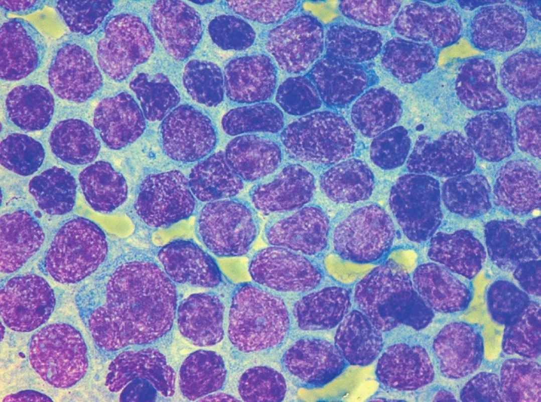 MCL, klasická morfologie s převažujícími centrocyty, imprint lymfatické uzliny, barvení May-Grünwald, Giemsa-Romanowski, světelná mikroskopie, zvětšení 1000krát