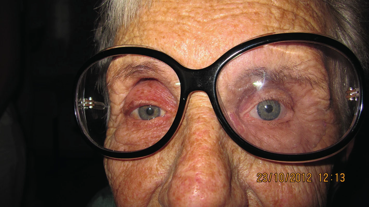 Fotografia pacientky po nasadení epitézy a okuliarov