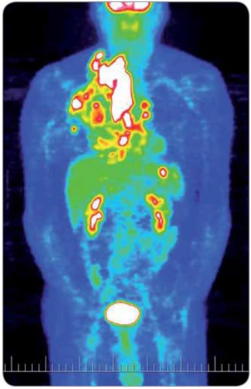 Obraz celotělového PET vyšetření před zahájením iniciální protinádorové léčby (4/2004). Světlá místa značí vysokou metabolickou aktivitu.