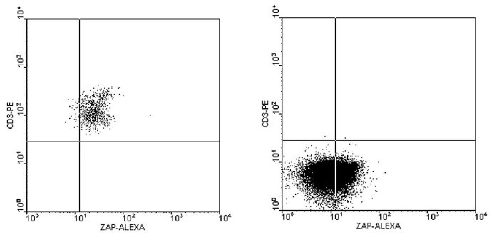 a–b. Imunofenotypizační vyšetření periferní krve u B-CLL s pozitivní expresí ZAP-70 na B-lymfocytech. Trojbarevné značení: ZAP-70-Alexa 488, CD3-PE, CD19-PC5.