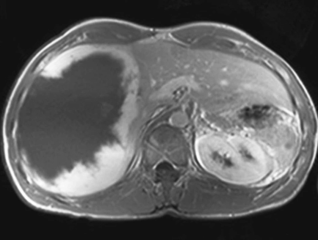 MRI jater – objemný hemangiom pravého laloku jater
Pic. 2. MRI of the liver – large hemangioma of the right liver lobe