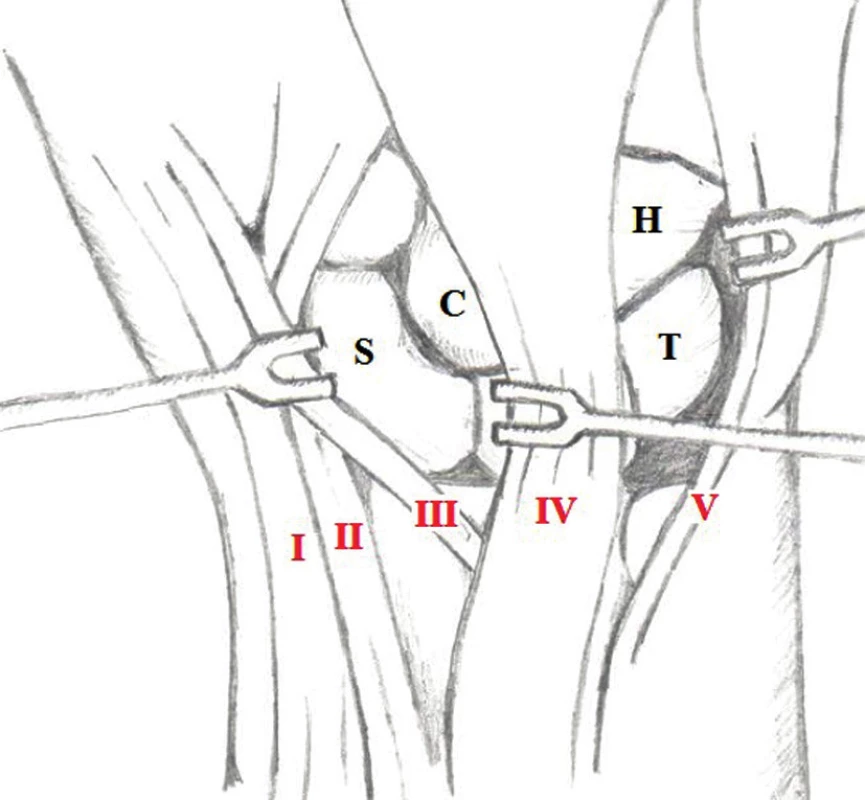 Schematický nákres dorzálního operačního přístupu pro provedení proximální karpektomie z incizí retinakula mezi III. a IV. a mezi IV. a V. extenzorovým kompartmentem (volně převzato z CALANDRUCCIO, J.H.. Proximal row carpectomy. J Am Soc Surg Hand. 2001, 1-2, 112-122). 