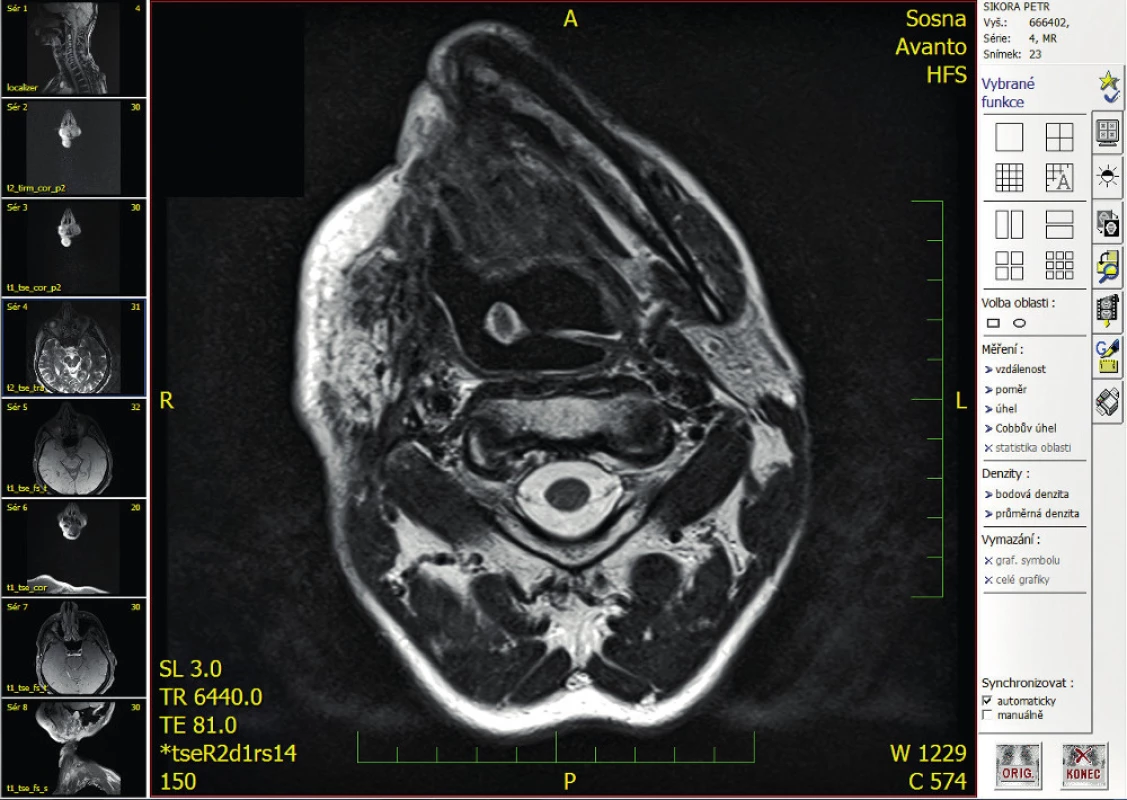 Řez MRI vyšetření s viditelnou deviací hrtanu do leva