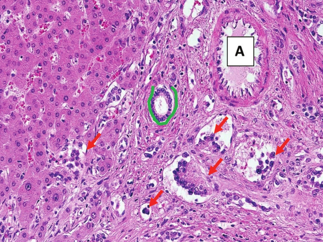 Epiteloidní hemangioendoteliom s šířením cévami
Větší portální pole s arterií (A) a žlučovodem (zeleně); ve větvi portální žíly i v drobných cévách jsou struktury epiteloidního hemangioendoteliomu (označeno červeně).
Fig. 6: Epithelioid hemangioendothelioma within vascular channels
Portal tract with an artery (A) and a bile duct (green). EHE is spreading in the small vessel channels and it is also visible in the branch of a portal vein (red arrows).