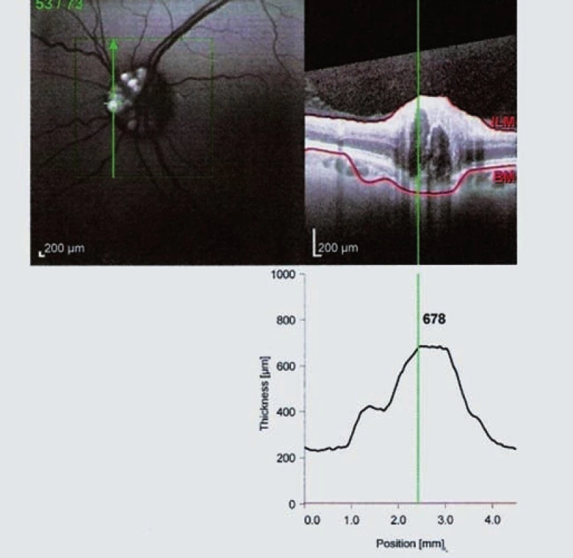OCT Spectralis – fundus autoflorescencia ľavého oka (pacient č. 1).
Drúzy sa zobrazujú ako hyperfluorescentné útvary. V pravej časti obrázka prierez predného úseku zrakového nervu OCT.