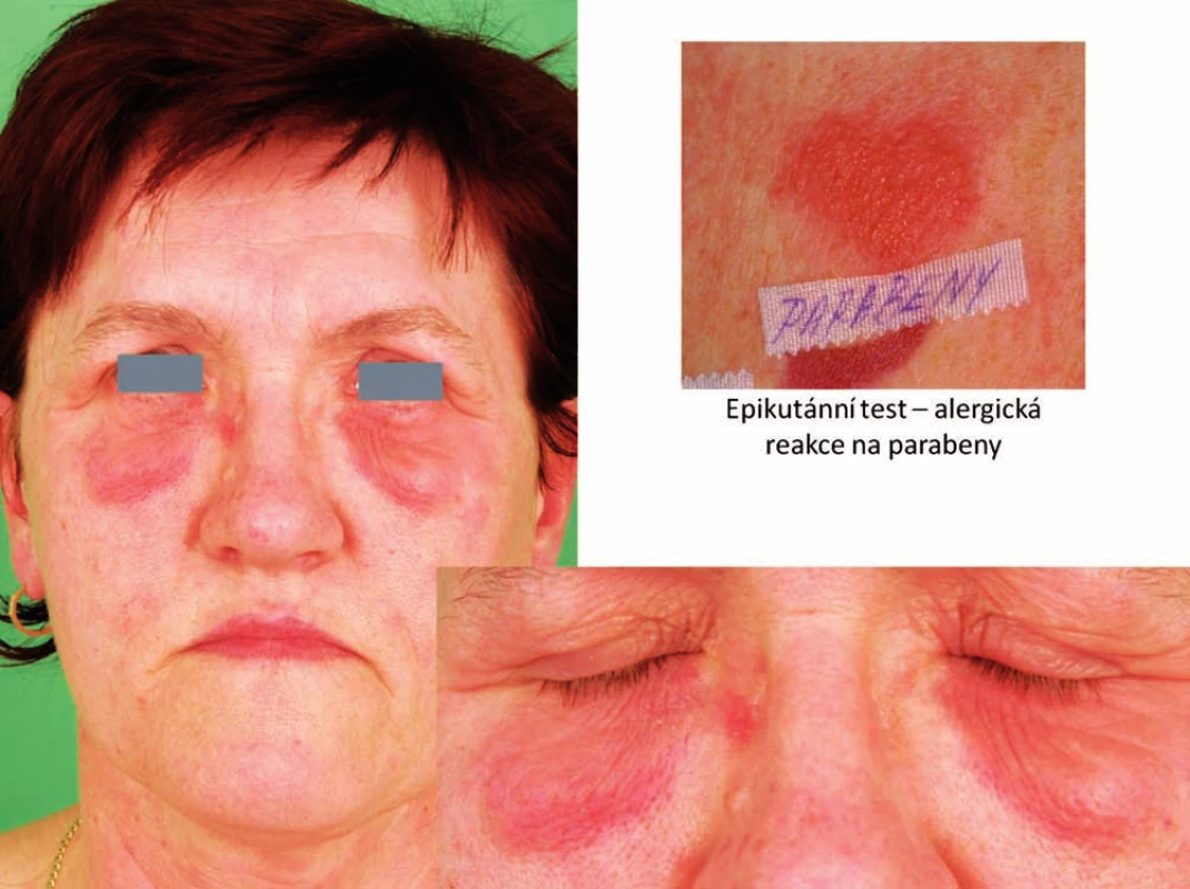 Eczema contactum – parabeny, alcoholes adipis lanae (přípravky farmaceutické)