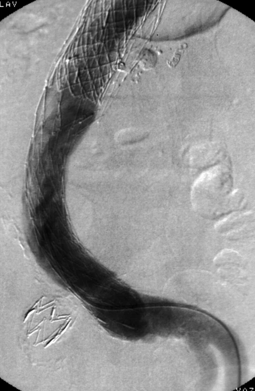 Poslední angiografie nově s rozvojem distálního endoleaku Ib ze společné iliacké tepny vlevo
Fig. 5. Last angiography with recent development of distal endoleak Ib from left common iliac artery