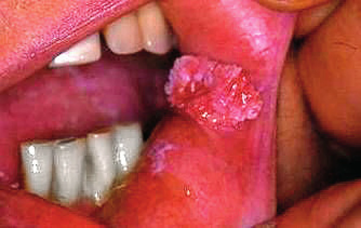 Verukozná leukoplakia v ústnom kútiku ( Ďurovič)