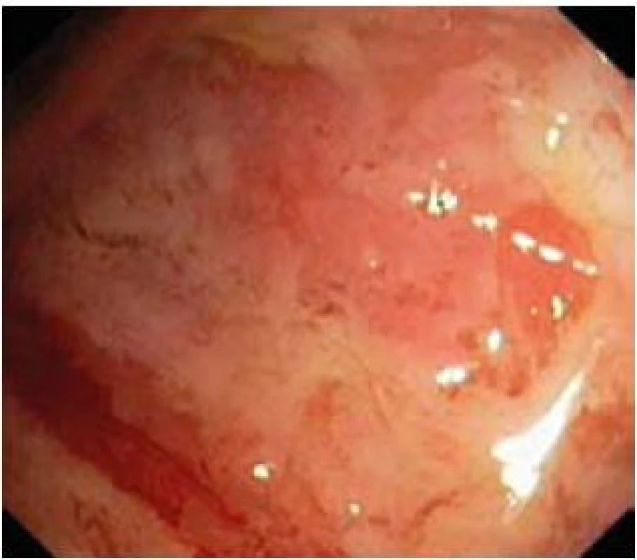 Aktivní fáze ulcerózní kolitidy se spontánním krvácením a plošnými ulceracemi (Mayo skóre 3).
Fig. 1. Acute phase of ulcerative colitis with spontaneous bleeding and superficial ulcerations (Mayo score 3).