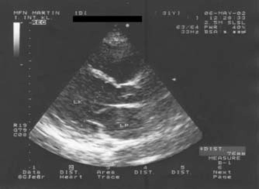 Echokardiografický obraz 29ročného muža, prijatého so srdcovým zlyhávaním, s dilatovanými dutinami srdca, výrazne redukovanou ejekčnou frakciou ľavej komory na 25 %, s difúzne zníženou kinetikou ľavej komory.