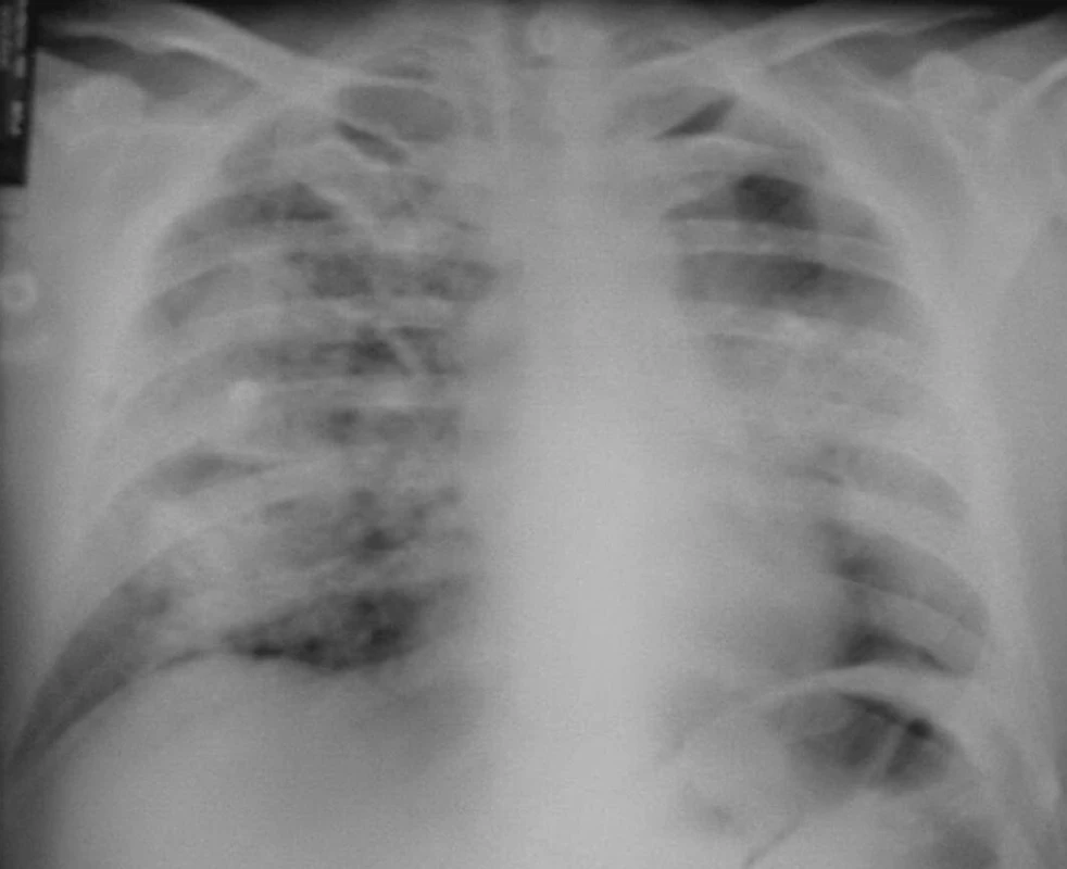 Plíce s projevy intraalveolárního krvácení – červen 2004.