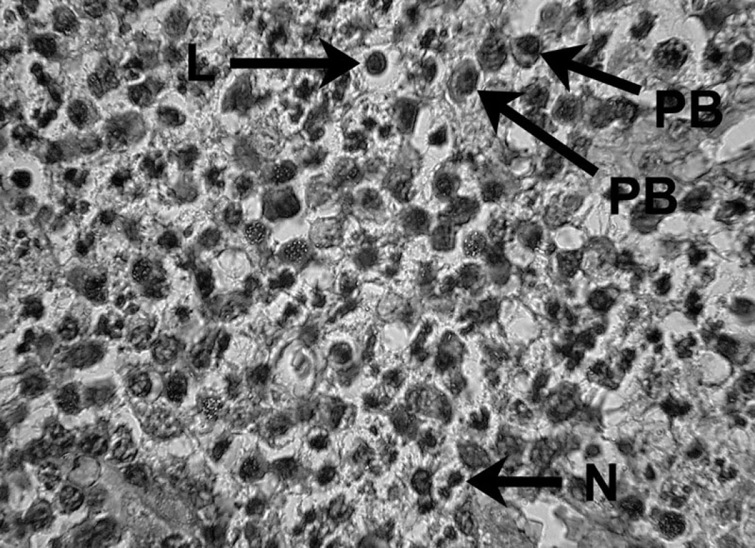 Zápalový bunkový infiltrát prítomný v periapikálnom granulóme V histopatologickom obraze lézie možno vidieť lymfocyt (L), plazmatické bunky (PB) a neutrofil (N) – autor Ján Kováč.
Fig. 5. Inflammatory cell infiltrate in periapical granuloma Histopathological image of the lesion shows a lymphocyte (L), plasma cells (PB), and a neutrophil (N) – Author Ján Kováč.