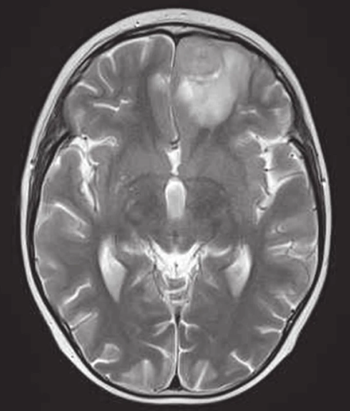 MRI mozgu, T1 vážený obraz postkontrastne (vľavo) a T2 vážený obraz (vpravo) v transverzálnej rovine. Metastáza frontobazálne vľavo – v T1 sýtiace sa ložisko s perifokálnym edémom do 16 mm, v T2 nehomogénna lézia ľahko hyperintenzná voči kortexu. [10.10.2013]