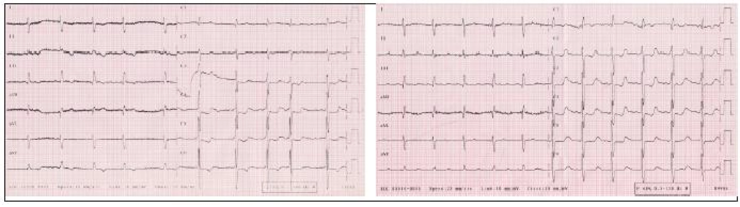 Vľavo: EKG z roku 2003, pravotyp, známky preťaženia pravého srdca, vpravo: EKG z roku 2005, oproti nálezu z roku 2003 v hrudných zvodoch progresia hypertrofi e a preťaženia pravej komory srdca.