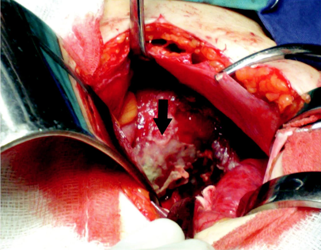 Peroperačný pohľad – zvyšky hnisavých pablán na povrchu maternice (čierna šípka)
Pic. 2. Peroperative view – residue purulent coat on the surface of uterus (black arrow)