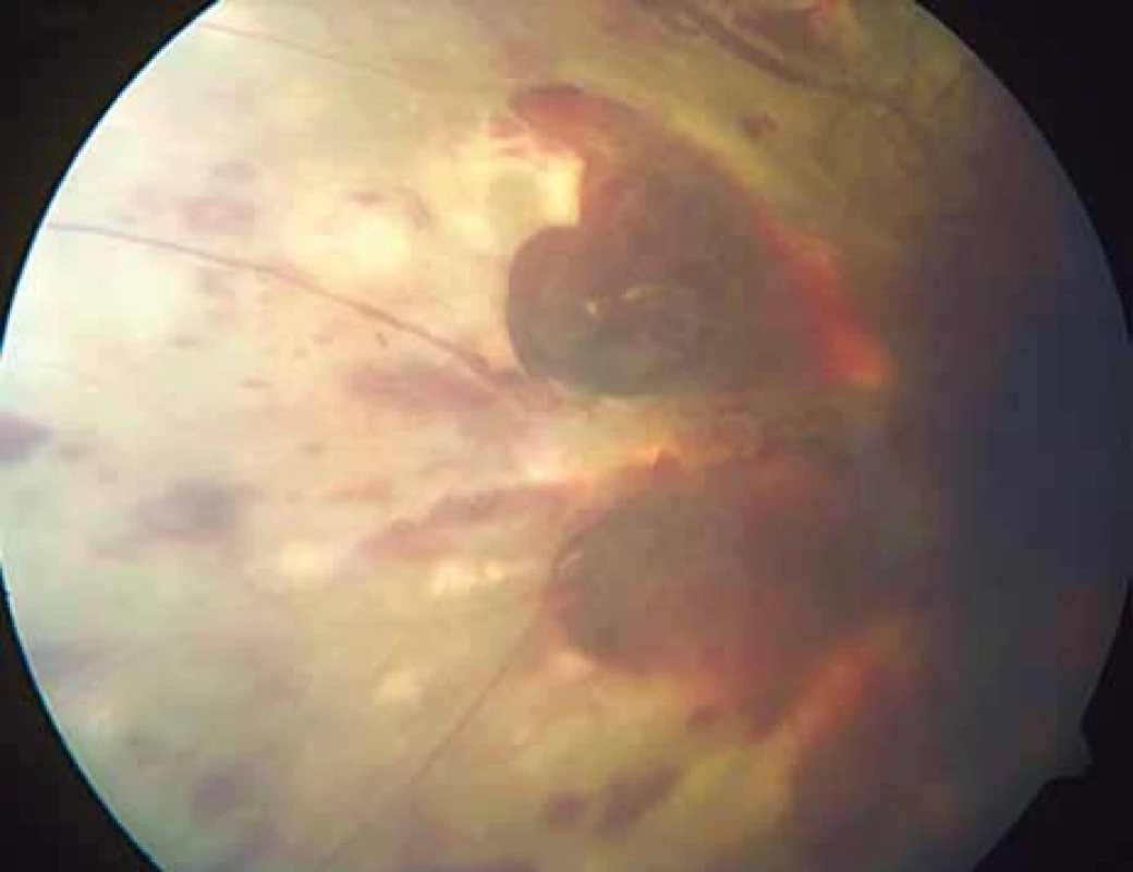 Pacientka č. 1: Fundus oka levého: proliferativní diabetická retinopatie, preretinální krvácení, těžká flebopatie v nazální polovině sítnice.