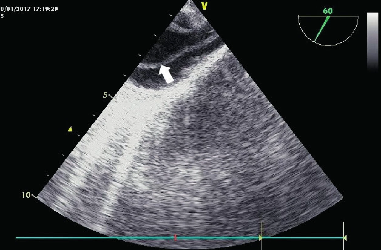 Odtržená intima na konci aortálního oblouku
TEE zobrazení hrudní aorty v krátké ose s odstupem levé podklíčkové tepny, do které zasahuje odtržená intima (bílá šipka).