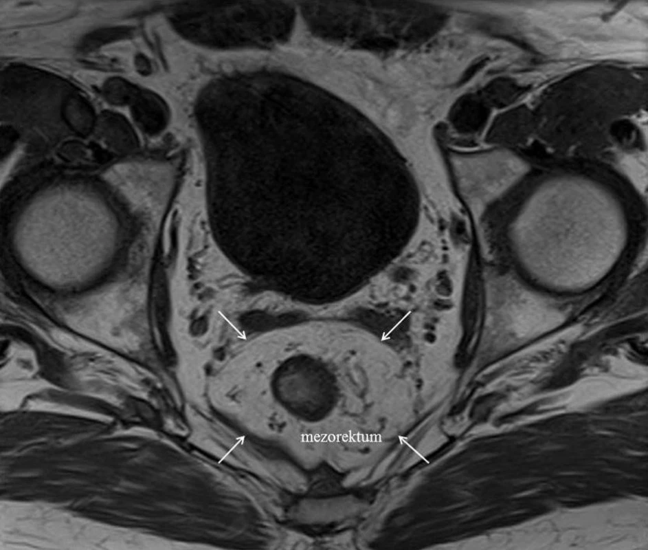 T1-vážený axiálny MRI scan tumorom rekta s vyznačením fascia recti propria (biele šípky), ktorá predstavuje potenciálny chirurgický CRM
Fig. 3: T1-weighted axial MRI through rectal tumour showing the fascia propria recti (white arrows), which presents potential surgical CRM