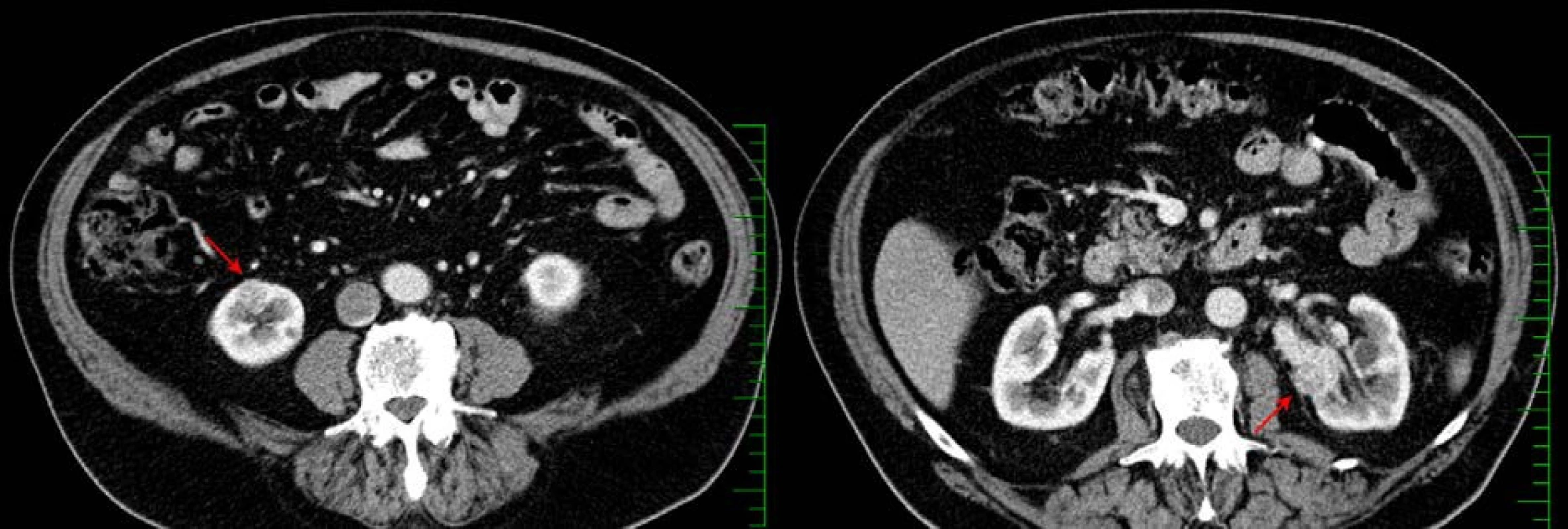 CT, transverzální řez, arteriální fáze: bilaterální světlobuněčný renální karcinom pT1a (červené šipky)
Fig. 3. CT scan, axial section, arterial phase: bilateral clear cell renal cell carcinoma pT1a (red arrows)