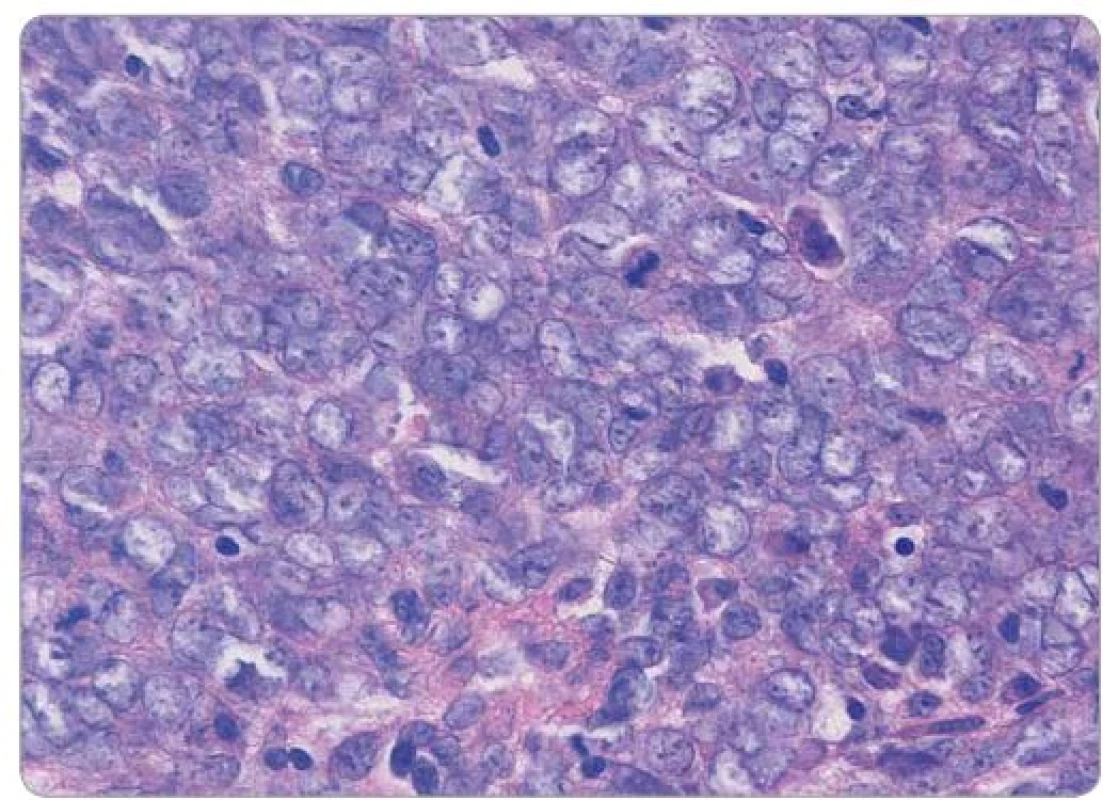 Histologický obraz Ewingova sarkomu děložního čípku, barvení hematoxylin-eosin, původní zvětšení 600×. Uniformní buňky se sporou až nepatrnou plazmou, jemným chromatinem a chybějícími či drobnými nukleoly, přítomny mitotické figury.