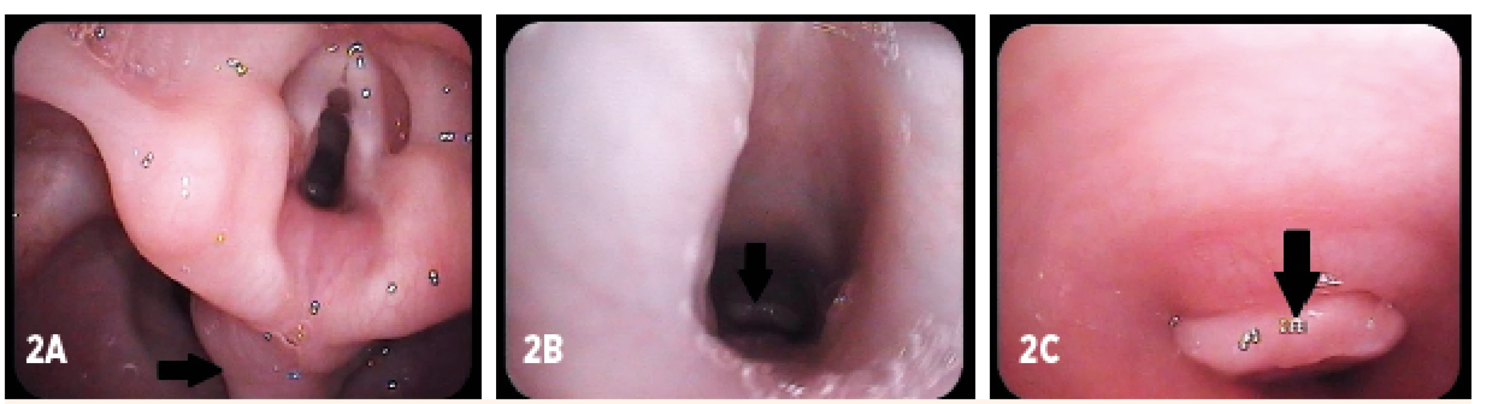 Kontrolná fibroskópia (vek dieťaťa 17 mesiacov). A – prolaps sliznice postkrikoidnej oblasti (šípka), B, C – granulácia v oblasti tracheostómie (šípka)
Fig. 2. Control fibroendoscopy (age of child 17 months). A – mucosal prolaps in the postcricoid area (arrow), B, C – granulation above the tracheostomy (arrow)