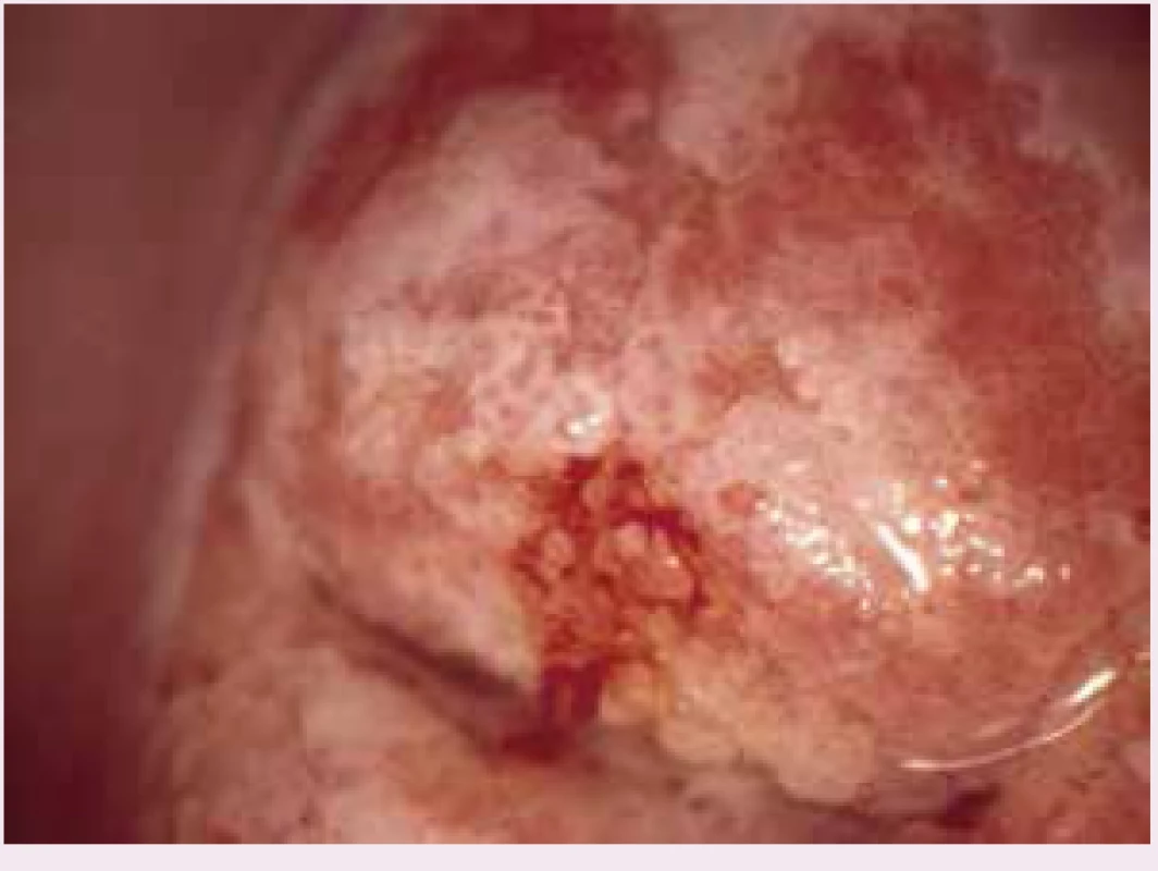 Kolposkopický obraz adenocarcinoma in situ – vzájemně splývající papily cylindrického epitelu, bílé po kyselině octové