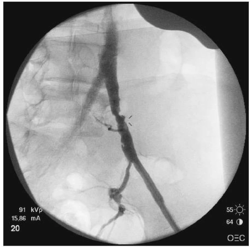 Snímek peroperační angiografie stenózy společné pánevní tepny
Fig. 2. Intraoperative angiographic view of the common pelvic artery stenosis