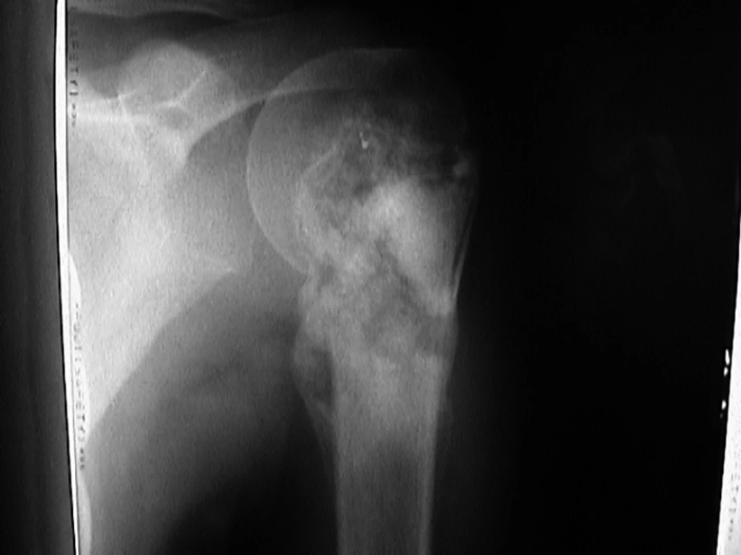 Rentgenový snímek pacienta s osteosarkomem proximálního humeru.