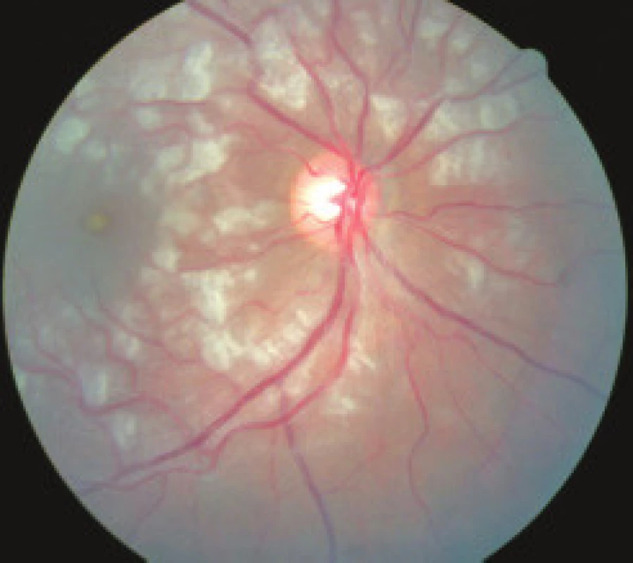 Pravé oko, obraz Purtscherovej retinopatie pri prijatí na Oftalmologickú kliniku s početnými belavými ložiskami okolo terča zrakového nervu.