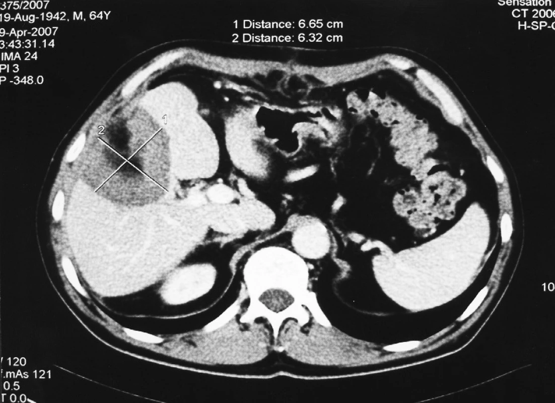 CT obraz 2 týdny po klínovité resekci metastázy v V. segmentu
Fig. 2. CT view, 2 weeks after the segment V metastasis wedge resection