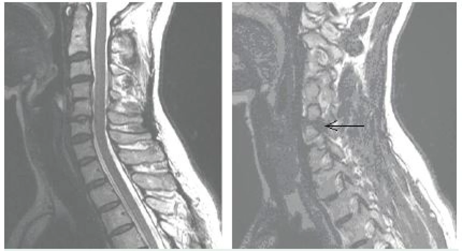MR vyšetrenie C chrbtice, A – synostóza C4-5, B – foraminálna hernia discus itervertebralis C 5-6 vľavo.
