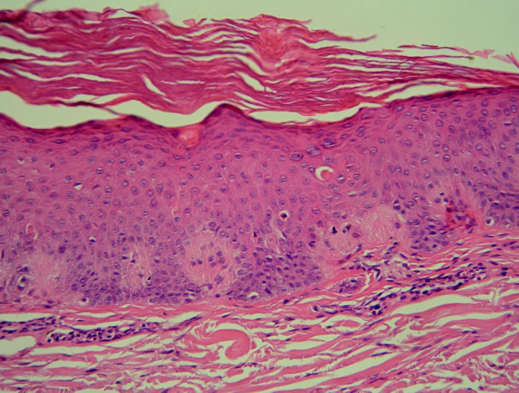 Histopatologický obraz LA – hyperkeratóza, hypergranulóza, akantóza, dilatované dermální papily díky shlukům amorfního nefibrilárního materiálu (HE, zvětš.100x).