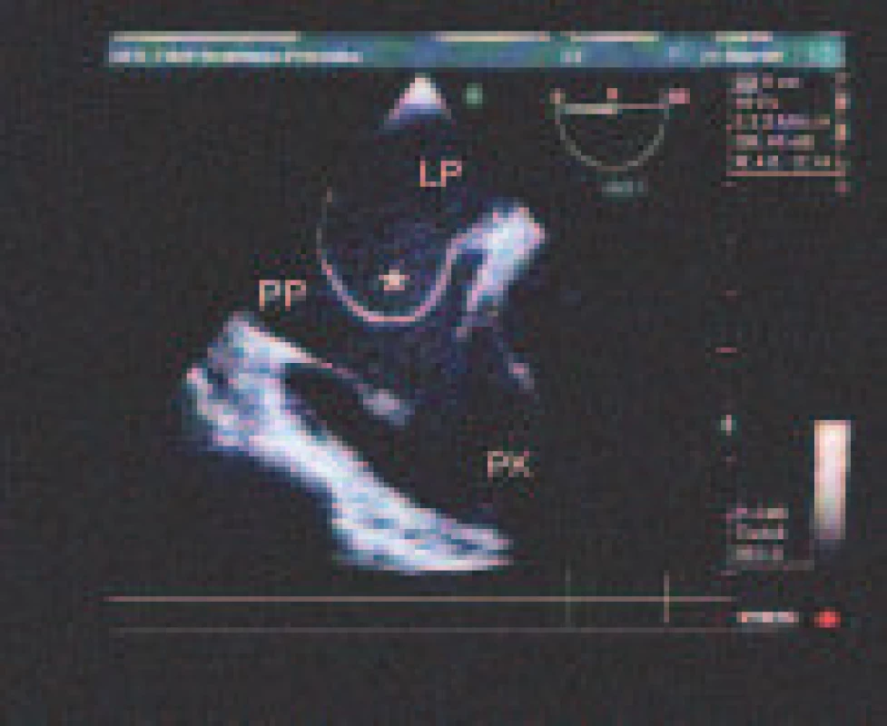 Veľká aneuryzma predsieňového septa (*) vyklenutá konvexitou do pravej predsiene (PP).
LP – ľavá predsieň
PK – pravá komora