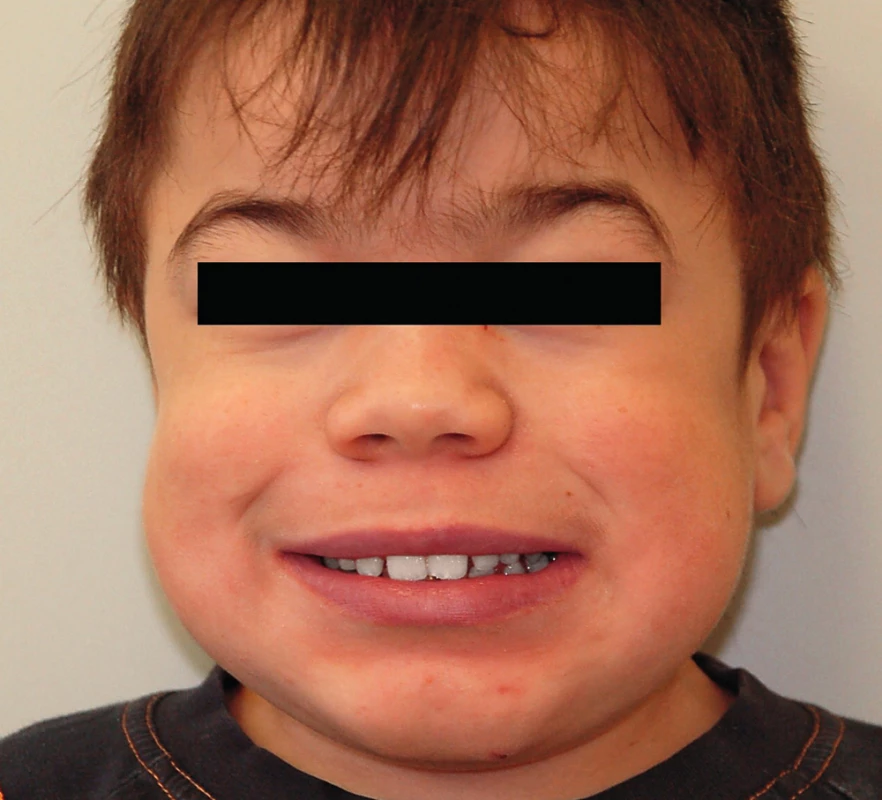 Typický vzhled dítěte s mukopolysacharidózou