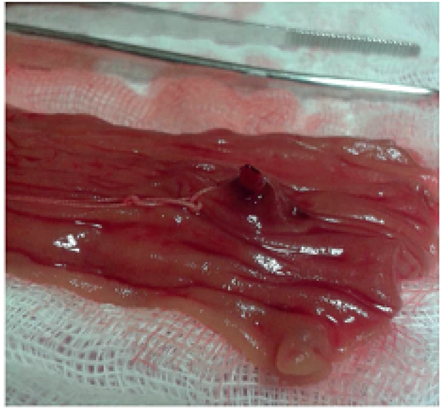 Zdroj krvácení do orálního jejuna – detail s patrným otevřeným lumen cévy
Fig. 3: Oral jejunum, source of bleeding – detailed view with open orifice of a vessel
