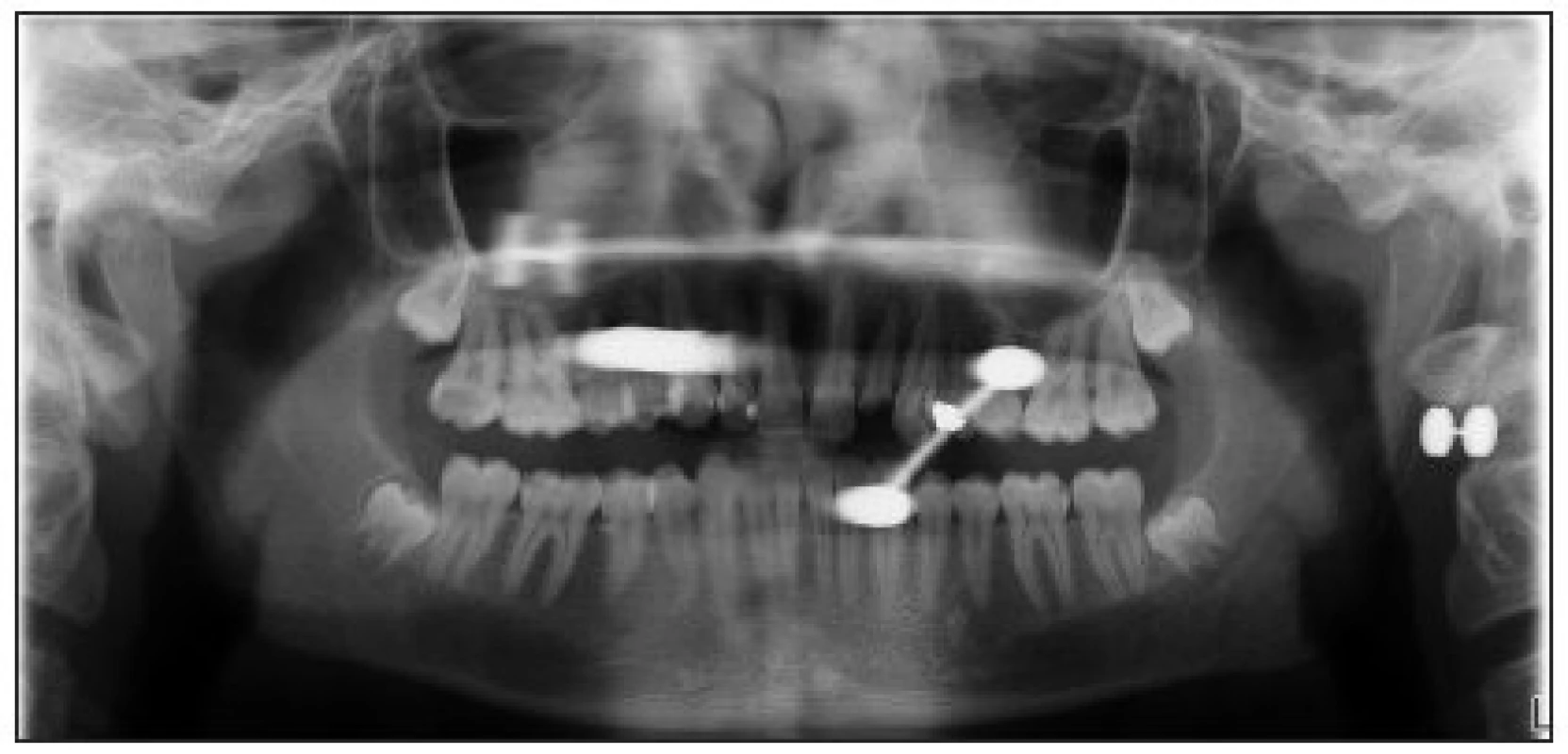 Snímek ukazuje syté stíny piercingu, které znehodnocují rentgenové vyšetření.