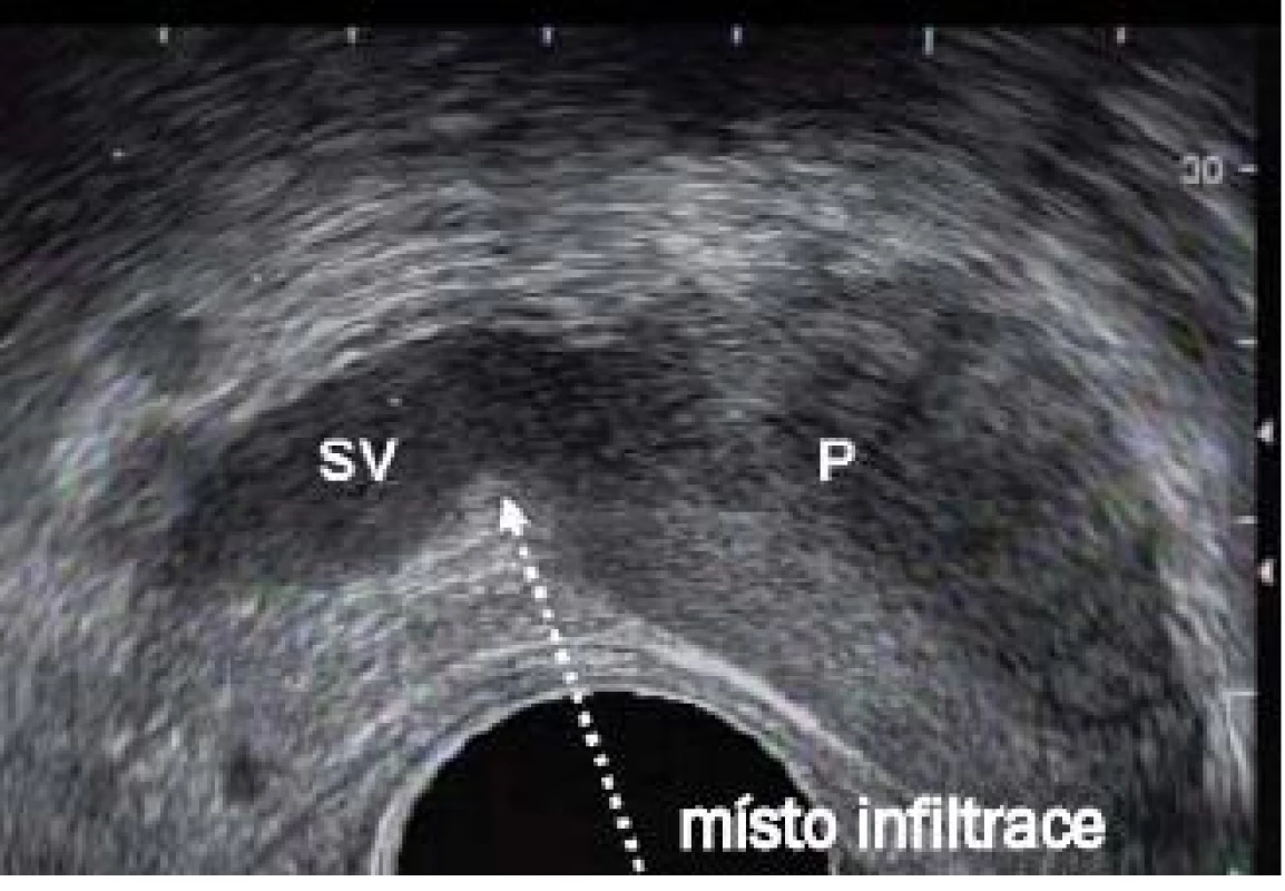 Sagitální zobrazení prostaty demonstrující místo periprostatické infiltrace do oblasti neurovaskulárního svazku na spojnici mezi semennými váčky (SV) a bází prostaty (P).