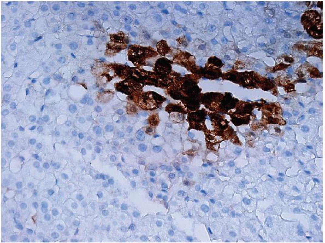 Imunohistochemický průkaz glutamin syntetázy v normálních játrech zaujímá 1 až 2 řady hepatocytů centrolobulárně. Rozšíření mimo tuto oblast by mělo být následováno průkazem β-cateninu.