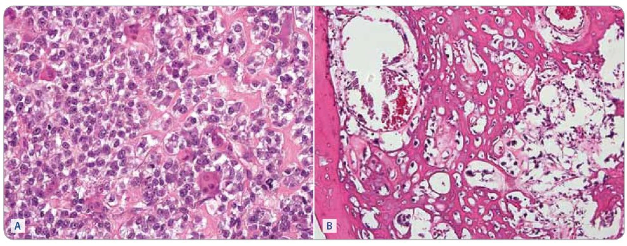 Osteosarkom, biopsie před zahájením (A) chemoterapie a po 6 cyklech léčby (B). Barvení hematoxylin a eosin, zvětšeno 400krát. (A) Nádor je silně buněčný, osteoblasty jsou velké, v tomto případě relativně uniformní, ale je patrná mitotická aktivita. v malém rozsahu je přítomna tvorba nádorového osteoidu, který je patrný jako homogenní nepravidelné pentlice mezi nádorovými buňkami v pravé části snímku. Zastiženy jsou také roztroušené nenádorové osteoklasty. (B) v nádoru převládá tvorba nádorového osteoidu, buněčnost je malá, nádorové buňky jsou však v tomto zorném poli vitální. V levé části obrázku je lamela spongiózy nenádorového původu.