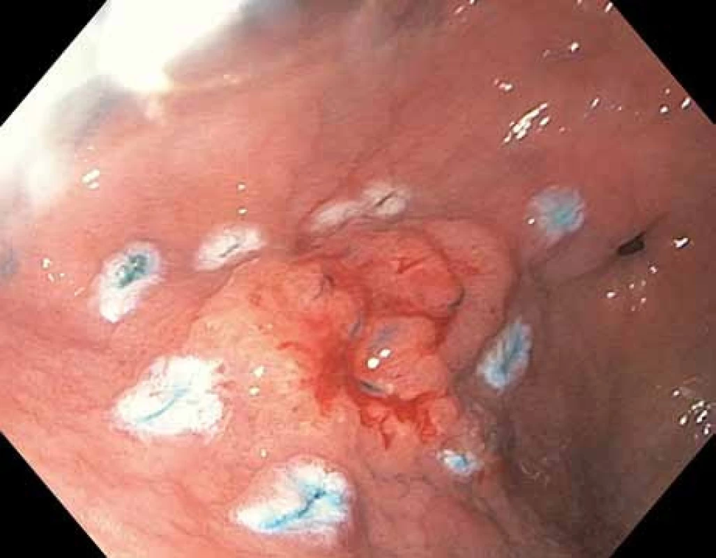 Endoskopická submukózní disekce (ESD) intramukózního karcinomu žaludku přední stěny antra žaludku – označení okrajů léze pomocí koagulačních bodů.