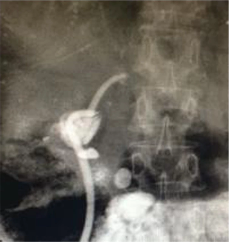 Self-made external-internal biliary stents and built-in plastic stents with multiple side holes were inserted across the stricture to prevent stricture recurrence
