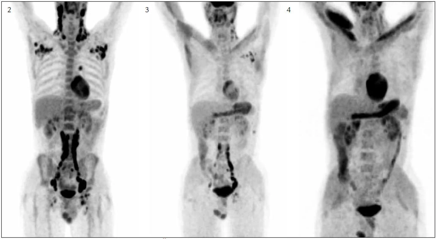 PET zobrazení před zahájením léčby. Černě se zobrazují dominantně lymfatické uzliny s vysokou akumulací fluorodeoxyglukózy.
Obr. 3. PET zobrazení po 4. cyklu léčby. Zřetelná je podstatně menší akumulace fluorodeoxyglukózy při srovnání s obr. 1.
Obr. 4. PET-CT zobrazení, po 7. cyklu léčby. Ve srovnání s obr. 2 a 3 došlo k výrazné regresi jak velikosti lymfatických uzlin, tak i míry akumulace fluorodeoxyglukózy v nich. Po 7 cyklech zůstávají již jen nepatrná rezidua. Fyziologickou variantou je zvýšená akumulace fluorodeoxyglukózy ve svalech v oblasti ramene vpravo.