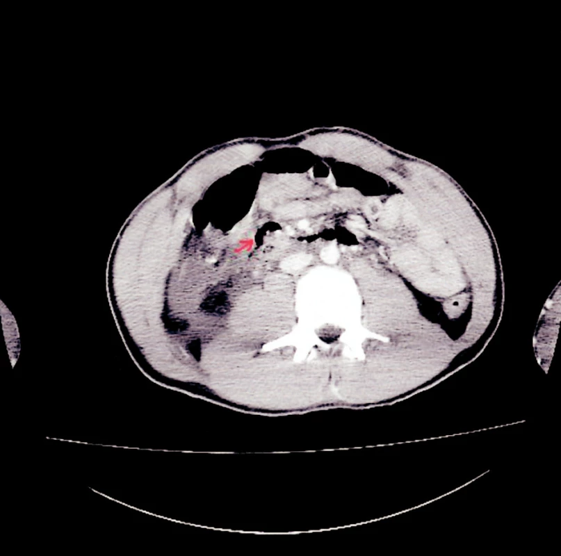 CT snímek – pneumoretroperitoneum
Fig. 3. CT view – pneumoretroperitoneum
