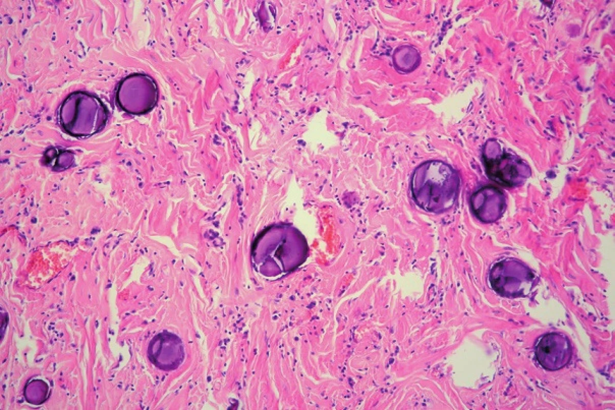 Calcifications occur mostly in the form of psammoma bodies (HE, 200x).