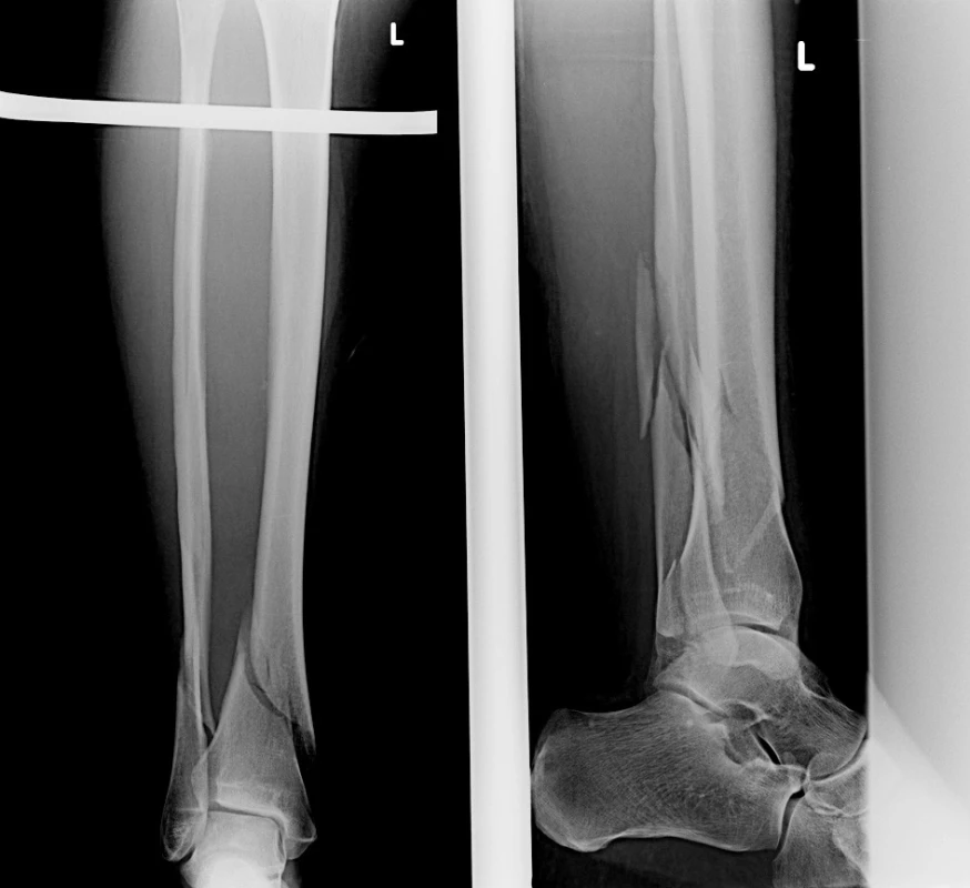 Vstupní rtg recentně po úrazu
Fig. 8: Initial X-ray shortly after injury
