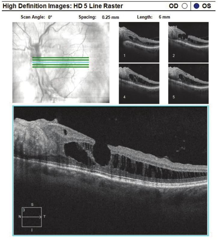 Optická koherenční tomografie levého oka: rozestup vrstev sítnice při dolní temporální arkádě s epiretinální fibrózou a defektem lamelárních vrstev sítnice